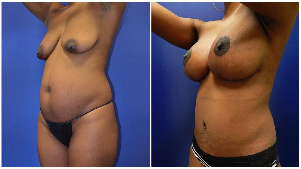 1breast3